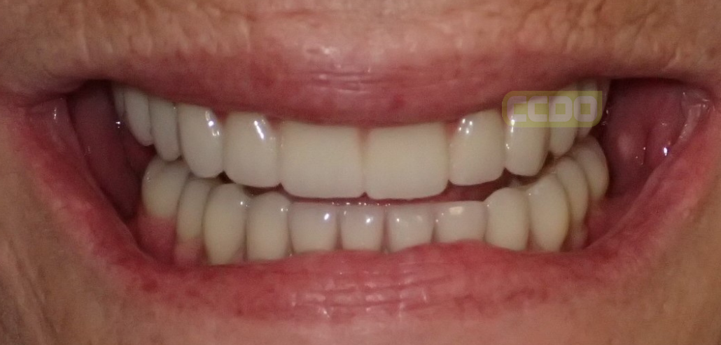 NEW TEETH FIXED ON IMPLANTS IN HOURS